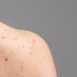 How to get rid of shoulder acne: 5 home remedies worth a try