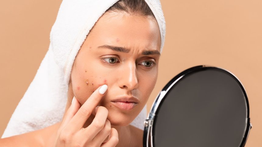 Say goodbye to cystic acne with these natural hacks!