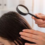 Home remedies for dandruff: Try eggs and yoghurt to soothe itchy scalp